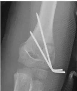 Fig. 2. Postoperation X-ray of closed reduction and percutaneous pin- pin-ning for a supracondylar fracture of the humerus.