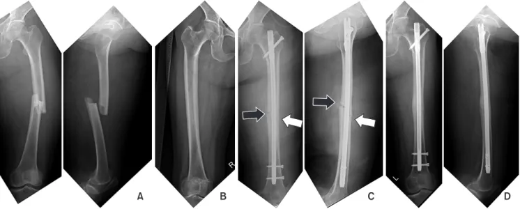 Fig. 1. (A) A 72-year-old female had a femoral diaphyseal fracture. (B) There are more than 5° of femoral bowing on the contralateral radiograph