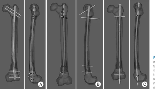 Fig. 8. Computation simulations of intra- intra-medullary nailing, including the  conven-tional technique (A), rotaconven-tional technique  (B), and cannulated femoral nail (CFN)  technique (C), were performed