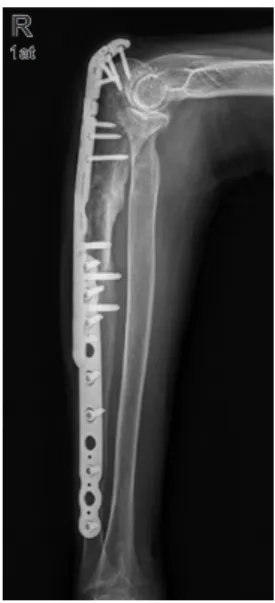 Fig. 5. The operation was performed with an olecranon plate and fore- fore-arm plate.