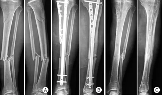 Fig. 3. A 57-year-old male patient had a  tibia segmental fracture in AO classifi ca  -tion 42-C2 after direct stroke and  crush-ing
