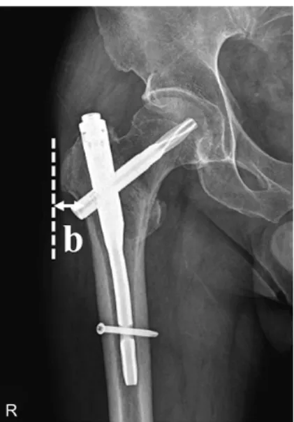 Fig. 3. Distance between the blade insertion site and the most lateral  protrusion point of the greater trochanter (b)