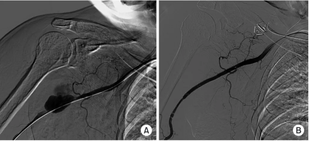 Fig. 3. (A) Right upper limb angiogram  demonstrates leakage of dye in the distal  third portion of the axillary artery