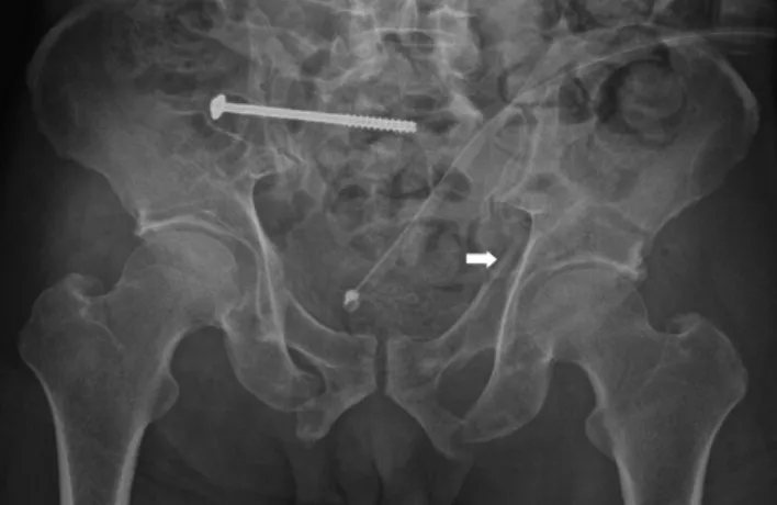 Fig. 1. Immediate postoperative radiograph shows the stabilization of  a pelvic ring injury, including left acetabular fracture (arrow).