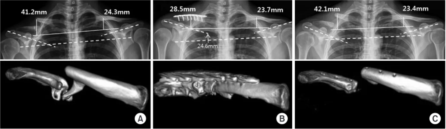 Fig. 1. Distance from the 1st rib to the clavicle of the non-union side changed from 41.2 mm (A, preoperative) to 28.5 mm (B, postoperative)