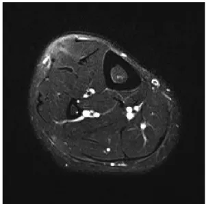 Fig. 1. Clinical photograph of the mass over the right leg.