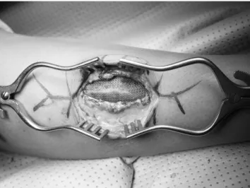 Fig. 6. Intraoperative photograph showing the fascial defect covered  with polypropylene non-absorbable synthetic surgical mesh beneath  the fascia.