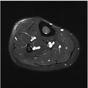 Fig. 7. Three-month follow-up magnetic resonance imaging scan  showing well repaired fascial defect using synthetic Mesh.