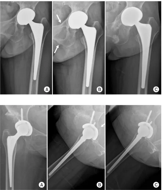 Fig. 2. (A) Postoperative radiograph of a  52-year-old female with developmental  dysplasia of the hip