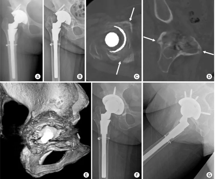 Fig. 3. (A) A 55-year-old female with secondary osteoarthritis due to tuberculosis sequelae underwent total hip arthroplasty