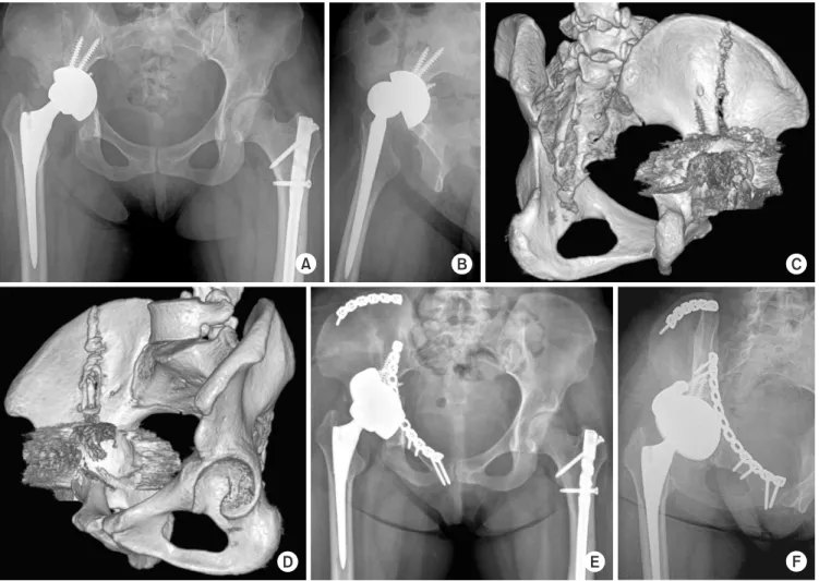 Fig. 4. (A, B) The acetabular prosthesis became unstable due to a traumatic periprosthetic acetabular fracture