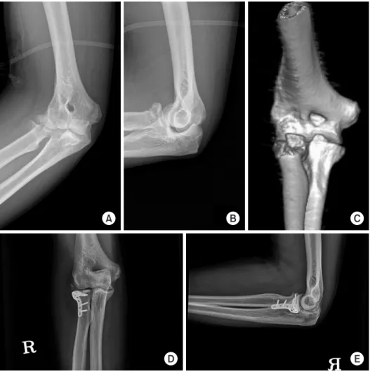 Fig. 2. A 57-year-old man sustained a  comminuted radial head fracture of the  right elbow after a fall from a 1 m height