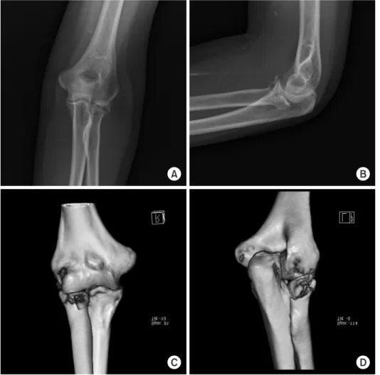 Fig. 4. (A, B) A 55-year-old woman fell  on the ground with an outstretched  hand and was diagnosed with a radial  head fracture on the left elbow at the  initial X-ray