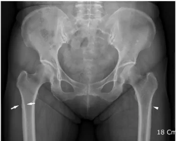 Fig. 6. Thickening of the lateral cortex in subtrochanteric regions is ob- ob-served on both sides