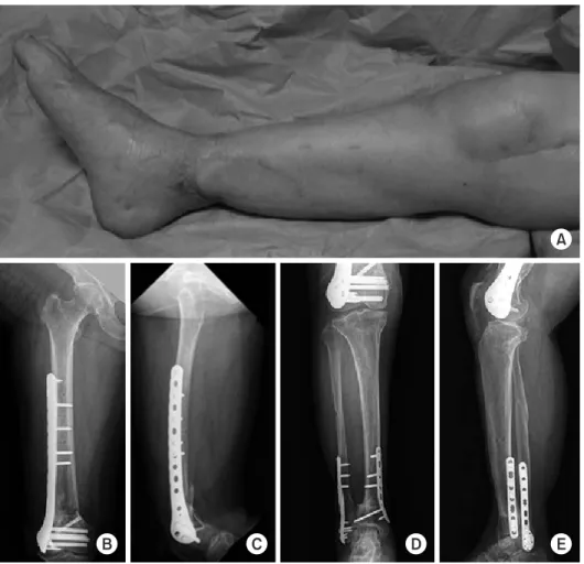 Fig. 3. (A) Rehabilitation therapy was  started after the soft tissue damage at  the surgical site had been cured