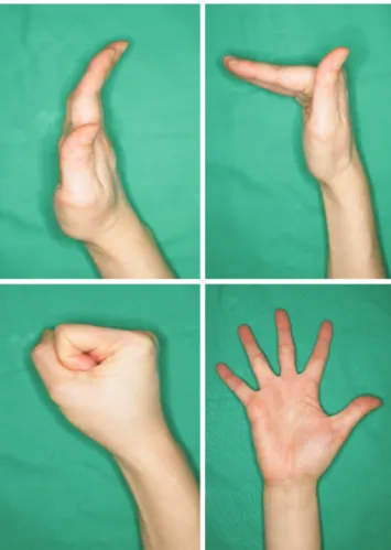 Fig. 3. Active finger range of motion exercise to prevent finger stiff- stiff-ness.