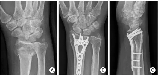 Fig. 1. (A) Plain radiograph and comput- comput-ed tomography showing intra-articular  fracture (AO type C2)