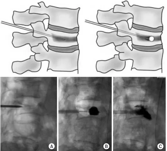 Fig. 1. Kyphoplasty for an osteoporotic  vertebral fracture. (A) Guide pin inserted  through the pedicle