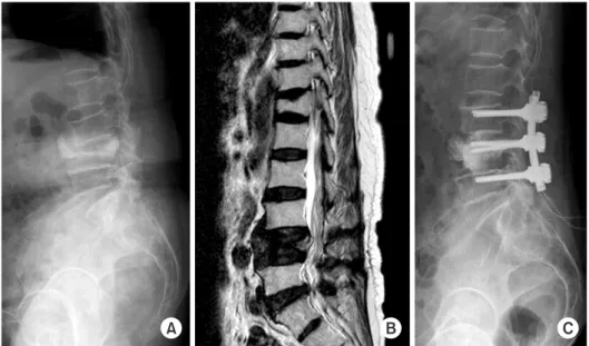 Fig. 2. Preoperative simple radiography  (A), preoperative magnetic resonance  im-aging (B), and postoperative simple  radio-graphy (C) of a 72-year-old female patient  who had an osteoporotic L4 vertebral  compression fracture