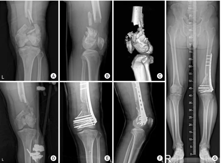 Fig. 1. (A, B) A 58-year-old man with an open distal femoral fracture. He had a severe open comminuted distal femoral fracture