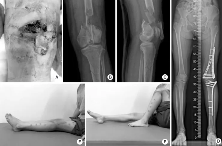 Fig. 2. (A) A 26-year-old woman with open distal femoral fracture. She had an open fracture and quadriceps muscle injury