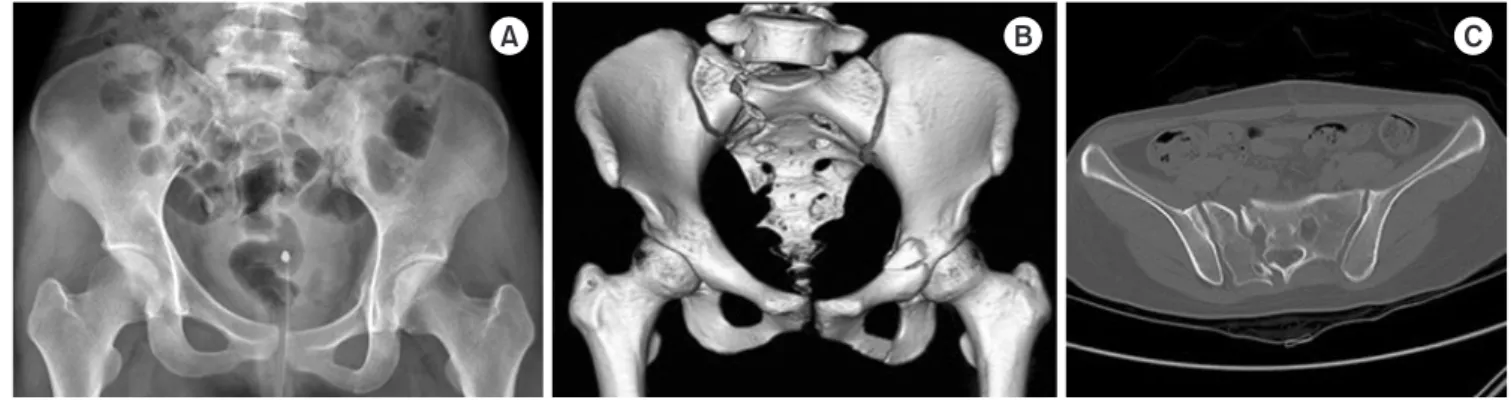Fig. 1. Anteroposterior pelvis radiograph (A), 3-dimentional computed tomography (CT) (B), and axial view of the CT (C) shows a fracture at the  right side of the sacral ala, sacral foramina, left anterior acetabulum, and right inferior ramus, right superi