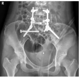 Fig. 3. Postoperative radiographs. Decompression and transpedicular  and spino-pelvic fixation, and iliosacral screw fixation were done.