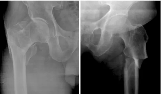 Fig. 1. Typical femoral fracture and atypi- atypi-cal femoral fracture.
