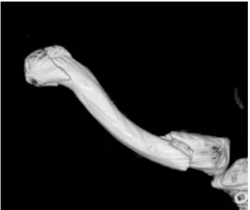Fig. 2. Computed tomography showed three-dimensional reconstruc- reconstruc-tion of the right clavicle.
