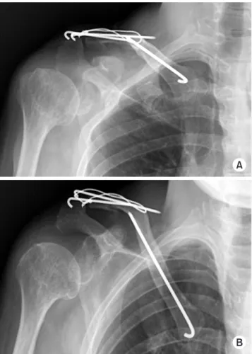 Fig. 5. Computed tomography showed a three-dimensional recon- recon-struction image of the right clavicle.
