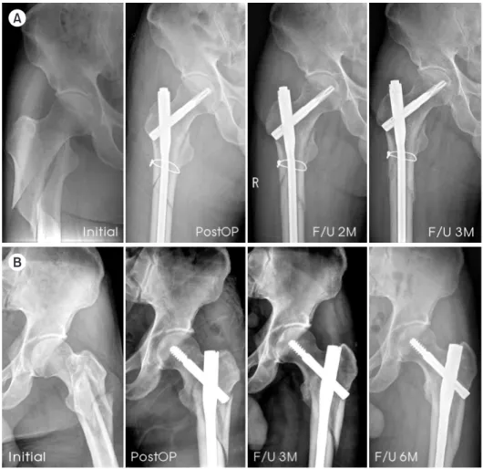 Fig. 3. (A) A 48-year-old man with wir- wir-ing: initial, immediately after surgery,  2-month follow-up (F/U) and 3-month F/