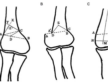 Fig. 2. Schemati drawing of supracondy- supracondy-lar quadrilateral displacement osteotomy