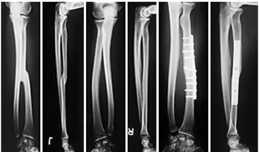 Fig. 6. Oblique corrective osteotomy  for a malunited diaphyseal fracture of  the forearm