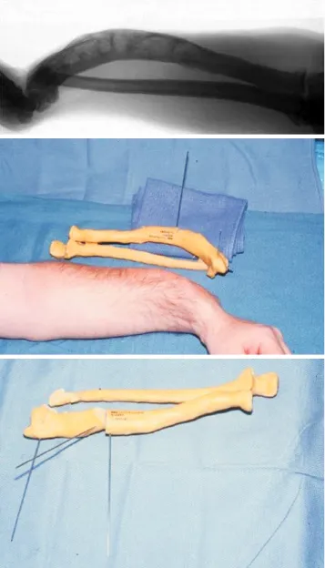 Fig. 7. Single-cut corrective osteotomy for a malunited diaphyseal  fracture of the forearm