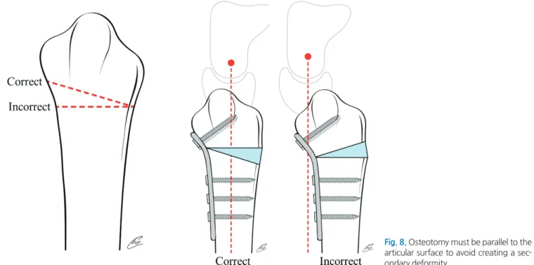 Fig. 8. Osteotomy must be parallel to the  articular surface to avoid creating a  sec-ondary deformity