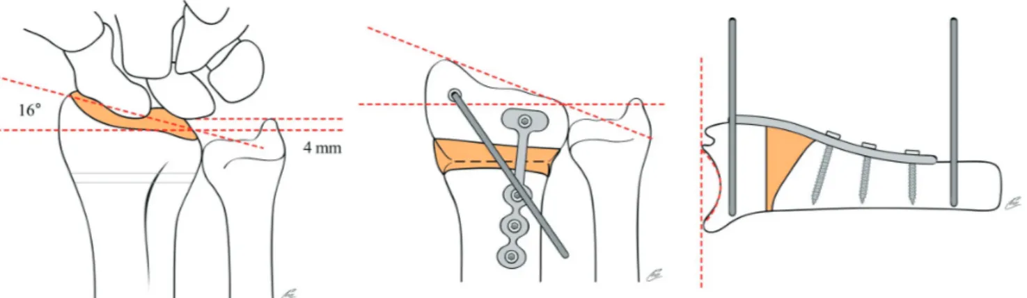 Fig. 9. Preoperative planning for the opening wedge dorsal osteotomy and fixation with the minicondylar plate