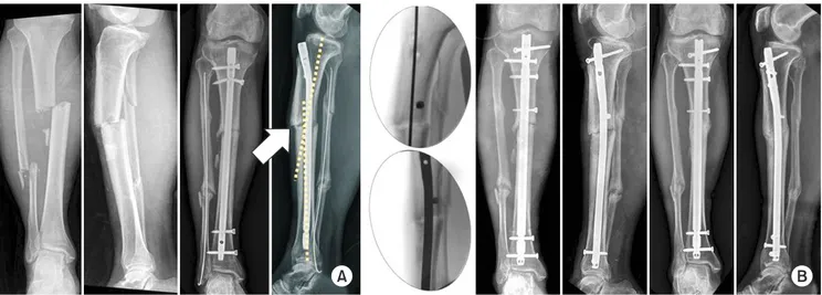 Fig. 2. (A) Valgus deformity was observed in the right distal femur as trauma at the growing age