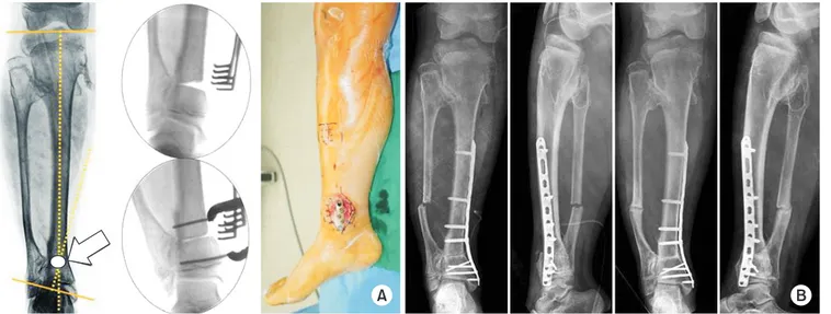 Fig. 4. (A) In a 13-year-old male with valgus deformity due to osteochondroma, center of rotation of angulation was located at the distal tibia (ar- (ar-row)