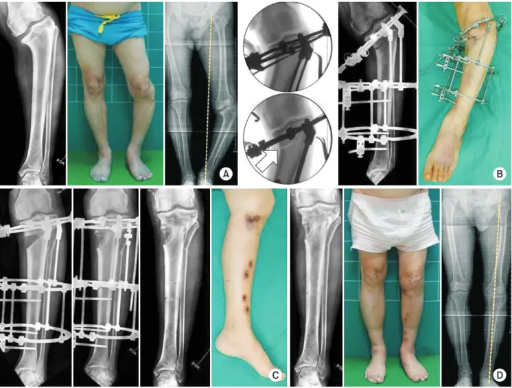 Fig. 6. (A) A 67-year-old man, who was suspected to have growth plate injuries in childhood, was confirmed to have varus deformity in the left  proximal tibia, and mechanical axis was shifted medially