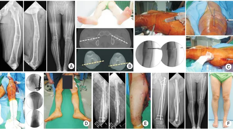 Fig. 7. (A) A 23-year-old man presented varus deformity after conservative treatment from a left femoral fracture at childhood