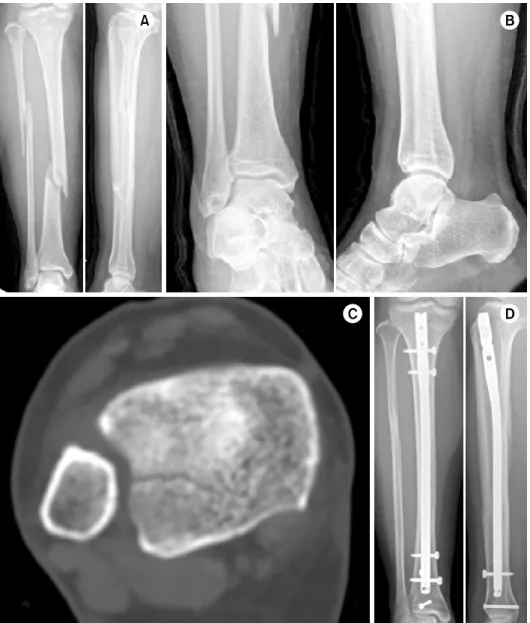 Table 3. Comparison between PM Diagnosed by Plain Radio- Radio-graph and CT Variable Diagnosed by radiograph  (n=20) Diagnosed by CT (n=32) PM mets indication of surgical fixation 16 26