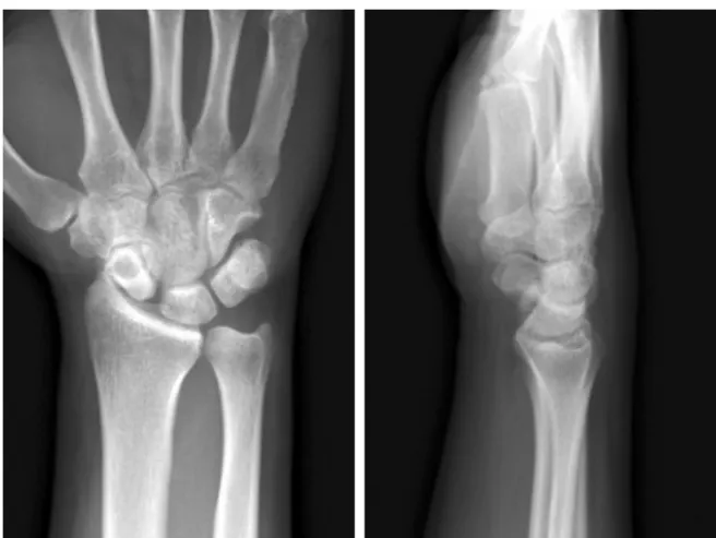 Fig. 2. Radiologic findings of the scapholunate dissociation. 