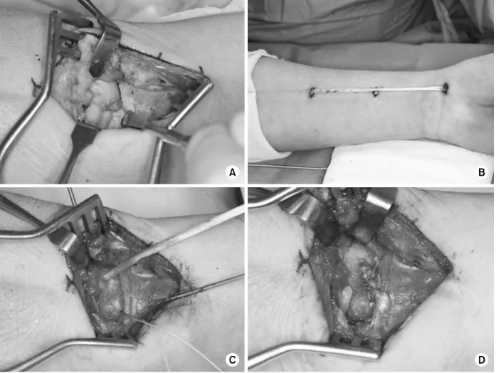 Fig. 3. Brunelli’s scapholunate ligament reconstruction using flexor carpi radialis (FCR) tendon