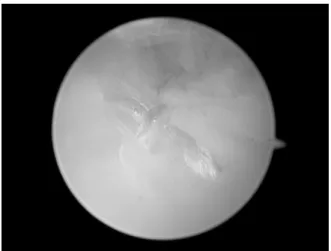 Fig. 6. Arthroscopic repair of the triangular fibrocartilage complex using double Fiberwire Ⓡ  suture.