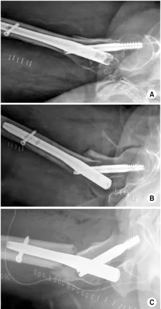 Fig. 1. Classification  of  quality  of  fracture  reduction  based  on  postoperative  lateral  radiographs