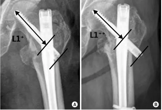 Fig. 2. Extent  of  sliding  dis- dis-tance.  (A)  Postoperative  X-ray. 