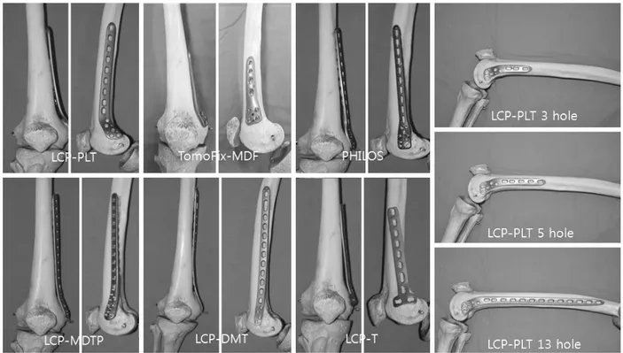 Fig. 1. Photographs  of  the  femur  bone  model  (3B  Scientific,  Hamburg,  Germany)  with  various  plates  on  medial  condyle,  locking compression  plate-proximal  lateral  tibia  (LCP-PLT),  tomoFix-medial  distal  femur  plate  (TomoFix-MDF),  prox
