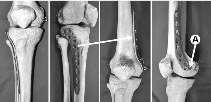 Fig. 2. Photographs  of  the  femur  bone  model  (3B  Scientific,  Hamburg,  Germany)  showing  the  application  of  locking  compression  plate-  proximal  lateral  tibia  (LCP-PLT)  on  appropriate  position