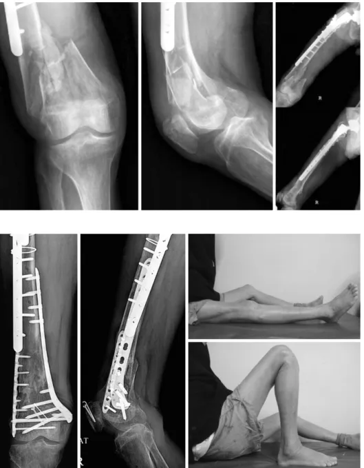 Fig. 5. Radiographs  and  photo- photo-graphs  of  the  right  femur  at  12  months  after  the  surgery  showing  good  fracture   heal-ing  and  good  range  of   mo-tion  of  the  right  knee.