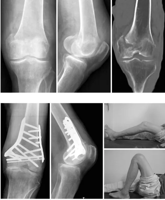 Fig. 6. Radiographs  of  the  left knee  and  the  coronal  section  of  computed  tomography  scan  of  the  left  knee  showing   se-verely  impacted  medial   con-dyle  fracture.